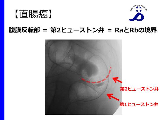 大腸癌診療における術前注腸X線検査の役割』